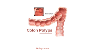 Read more about the article What are Colon Polyps? Learn Now!