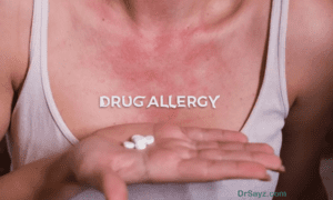 Read more about the article Drug Allergy – What is it and how to deal with it?