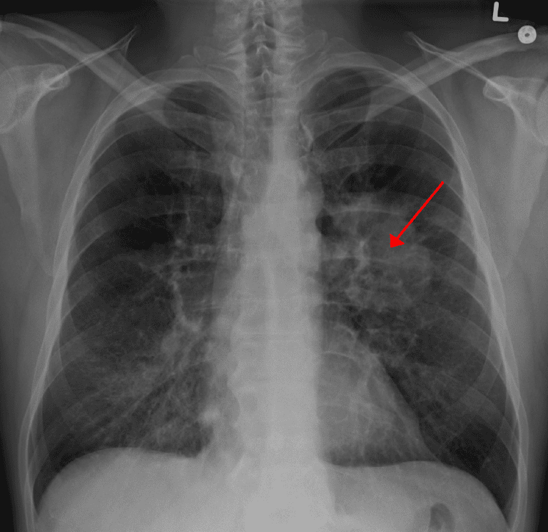 cancer of lung