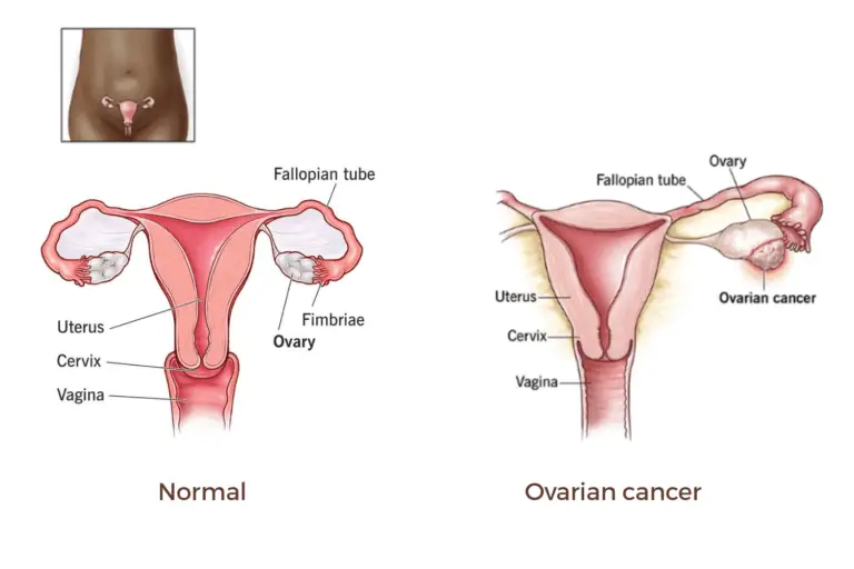 ovarian cancer