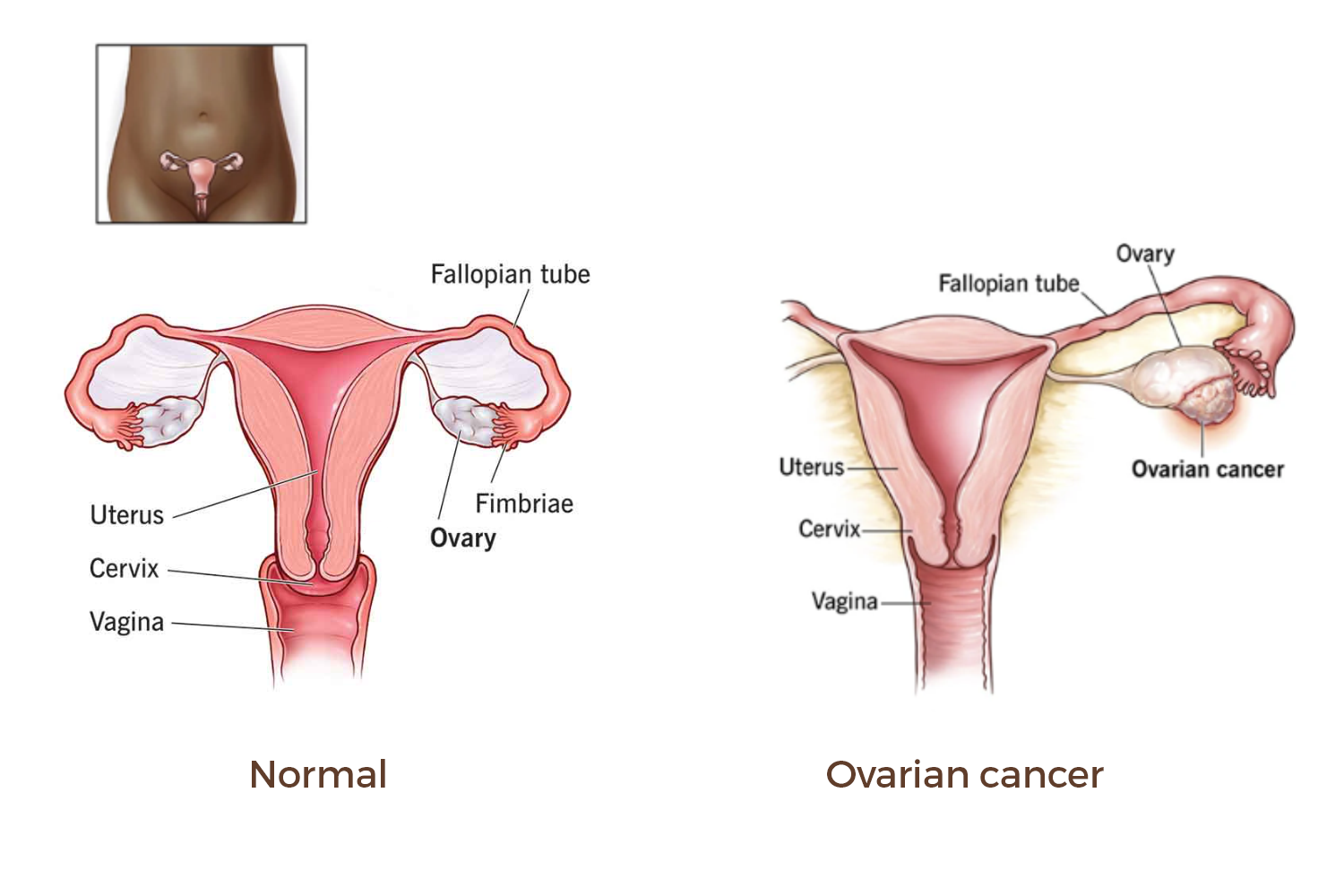 what-is-ovarian-cancer-screening