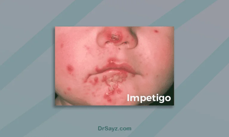Impetigo