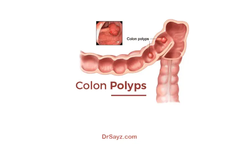 Polyps