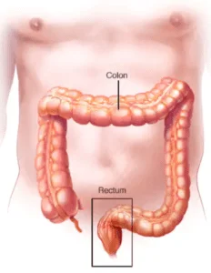 colon and rectum or colorectal