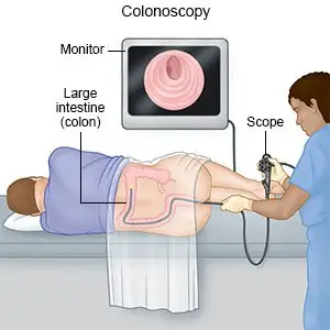 colonoscopy