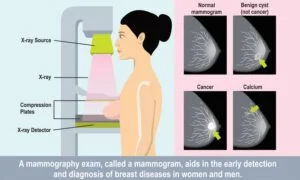 mammography for breast cancer screening