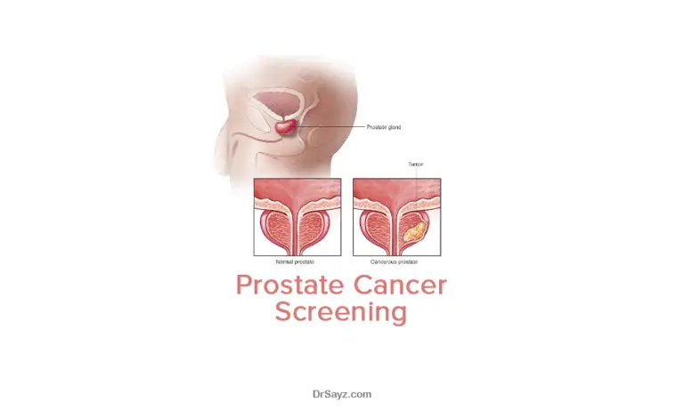 Image of the prostate gland for post prostate cancer screening